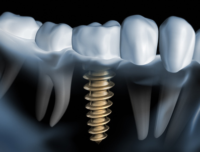 Pachetto per 1 impianto - Clinica dentale Smile