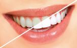 Package Whitening - Dental clinic Smile